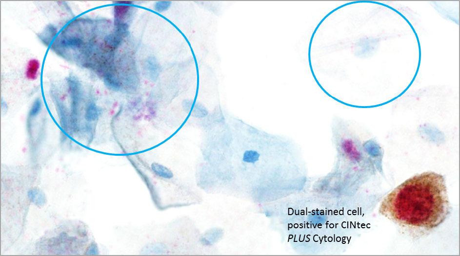 positive for CINtec PLUS Cytology The non-specific red
