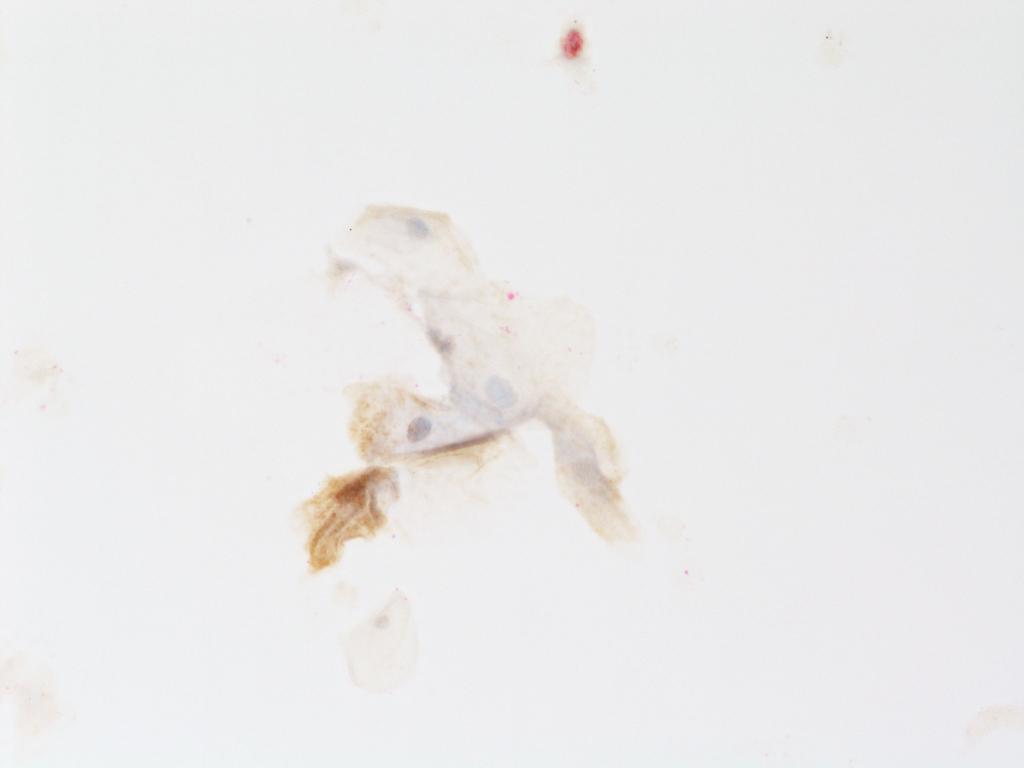 Figure 3.25: Inconsistent or uneven counterstaining of the reference squamous cells with a brown background This artifact may be associated with poor tap water quality.
