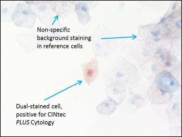 with weak, cytoplasmic p16 staining and weak nuclear Ki-67 staining, positive for CINtec PLUS Cytology