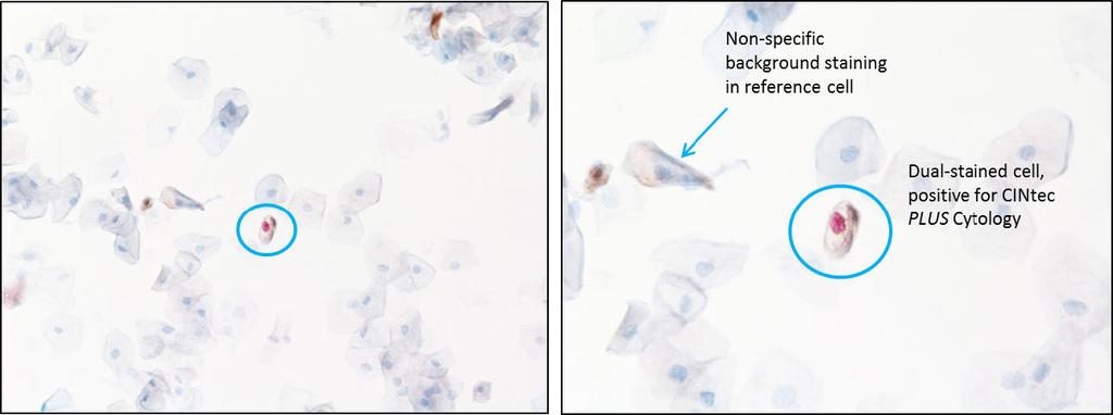 Figure 4.8: An isolated cell, suspicious for being dual-stained, with specific nuclear Ki-67 staining and questionable p16 staining.