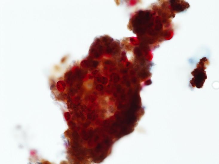6. CINtec PLUS Cytology staining is: Positive Negative