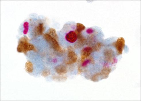 3. Cluster of squamous cells showing focal p16 staining and a few cells with Ki-67 stained nuclei, negative for CINtec PLUS Cytology 4.