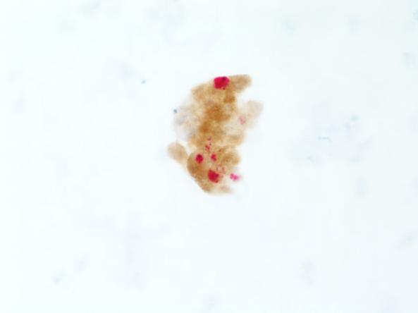 11. Cluster of squamous cells with one dual-stained cell at the edge of the cluster, diffuse, specific p16 staining, and a few nuclei with specific Ki-67 staining embedded in the cluster, positive