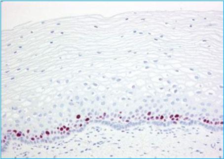 Figure 1.3 Normal cervical squamous epithelium immunostained with Ki-67 The combination of both p16 and Ki-67 immunostaining is important when evaluating cervical cytology specimens.