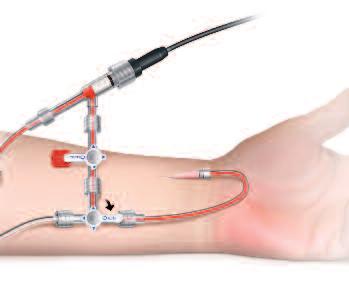 line to monitor fluids when used with the PulseCO TM algorithm Dual finger cuff with automatic finger switching for safer non-invasive use Non - Invasive Calibrated