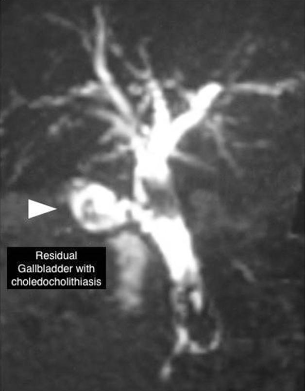 38 Ann Hepatobiliary Pancreat Surg Vol. 22, No. 1, February 2018 Fig. 1. MRC reconstruction displays a residual gallbladder with a stone (marked with solid arrow), as well as choledocholithiasis (marked with hollow arrow).