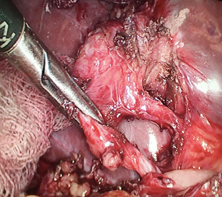 4%) patients; whereas, laparoscopic completion chol- There was no mortality and the postoperative morbidity ecystectomy was attempted in 48 (51.