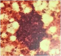 1: Invasive carcinoma, NOS FNAC (10x). Showing high cellualarity, with loosely cohesive clusters of cells showing nuclear pleomorphism & clumped chromatin. Fig. 2: Papillary carcinoma FNAC (20x).