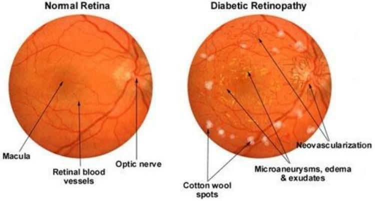 diabetes damages tiny vessels inside the retina. These tiny vessels will leak blood and fluid on the retina forms features such as microanurysns, hemorrhages, hard exudates, cotton wool spots.