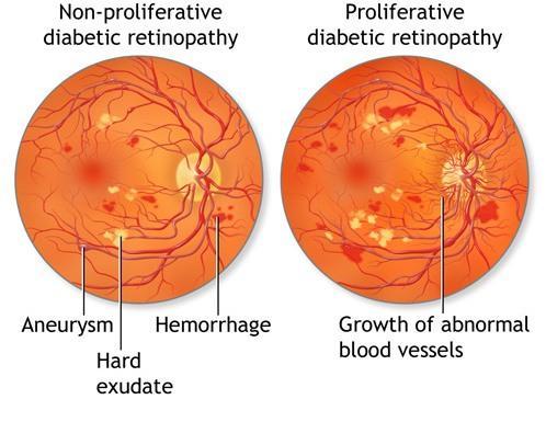2.1 Diabetic Retinopathy Image Database Figure 2: Stages of Diabetic Retinopathy A necessary tool for reliable evaluation and comparison of medical image processing algorithms is a database including