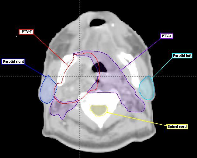 Figure 3. An original transverse CT-image section of case 1. The image high-lights the overlap between the right parotid gland and the PTV-T.