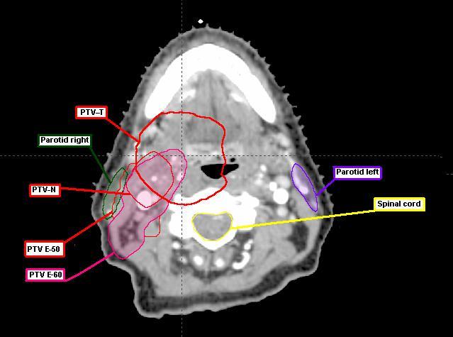 Figure 4. An original transverse CT-image section of the second H & N case, case 2. The image illustrates the overlap between the right parotid gland, PTV-T, PTV-E 50 and PTV-E 60.