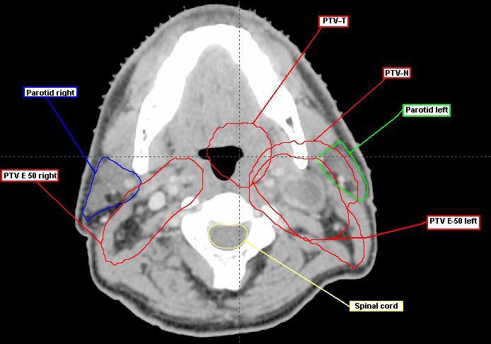 Figure 5. An original transverse CT-image section for case 3. Note the overlap between the left parotid gland, and PTV-N as well as the overlap between the same parotid gland and PTV E-50 left.