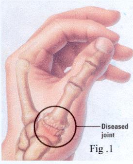 P a g e 10 Arthritis at the Base of the Thumb Any condition that inflames or destroys a joint is called arthritis.