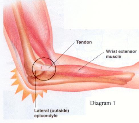 P a g e 13 Lateral Epicondylitis Lateral epicondylitis, commonly known as tennis elbow", is inflammation of the tendons in the upper forearm which straighten the fingers and extend the wrist.