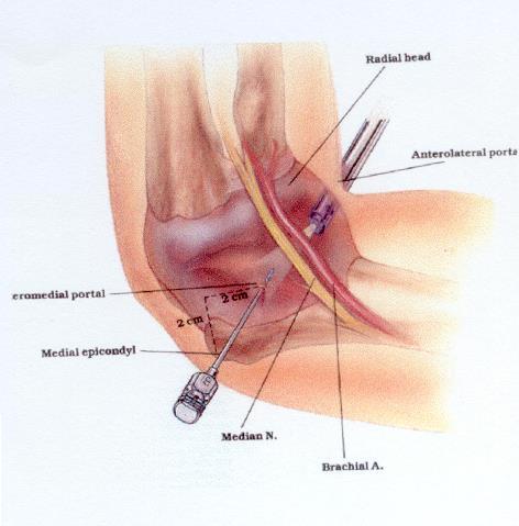 P a g e 14 Elbow Arthroscopy Elbow arthroscopy is "keyhole" surgery of the elbow joint.