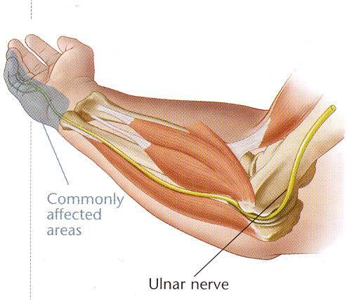 P a g e 6 Cubital Tunnel Release Cubital Tunnel Syndrome occurs when the ulnar nerve is compressed at the back of the elbow ( funny bone ).