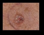 What is Basal Cell Carcinoma? BCCs are abnormal, uncontrolled growths or lesions that arise in the skin s basal cells.