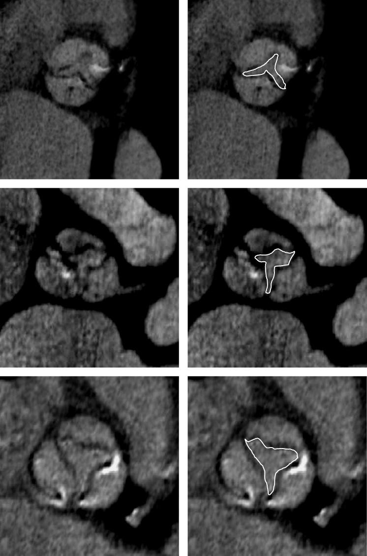 Computed tomography in aortic stenosis 1123 Coronary artery anatomy Coronary angiography displayed 33 significant lesions in 13 patients: 24 stenosis.