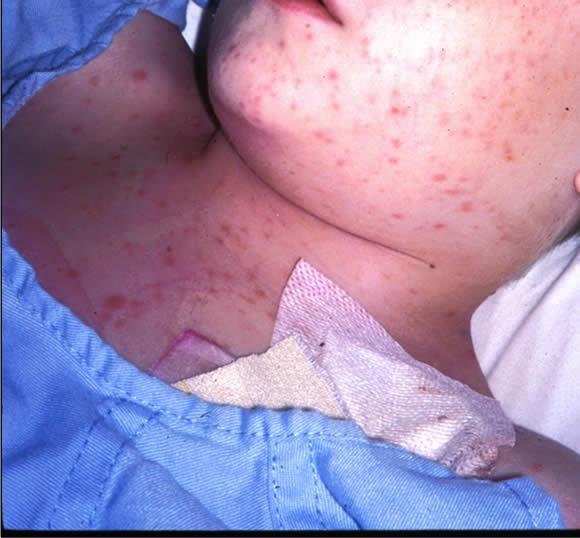 Paleness Tiredness and breathlessness Frequent and persistent infectins These are caused by a lack f healthy red and white cells and platelets in the bld.