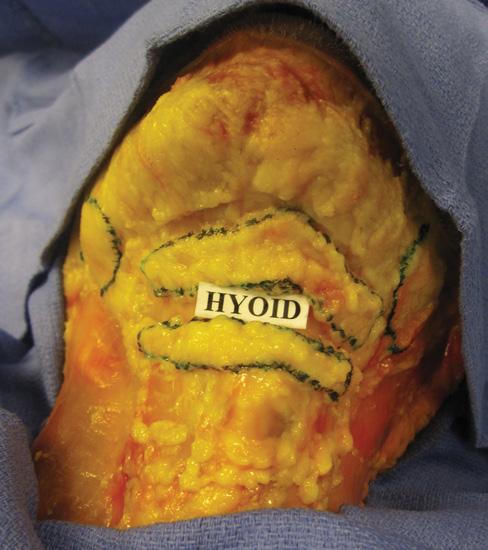 others 10,11 and to determine the relative distribution and variability of fat in these compartments. Methods Ten fresh cadaver heads were utilized.