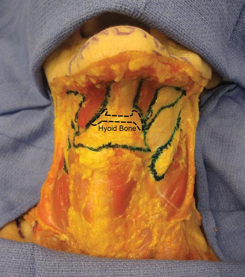 Larson et al 501 Figure 3. The subplatysmal fat compartment, located between the platysma and the submental musculature, is shown in a cadaver.
