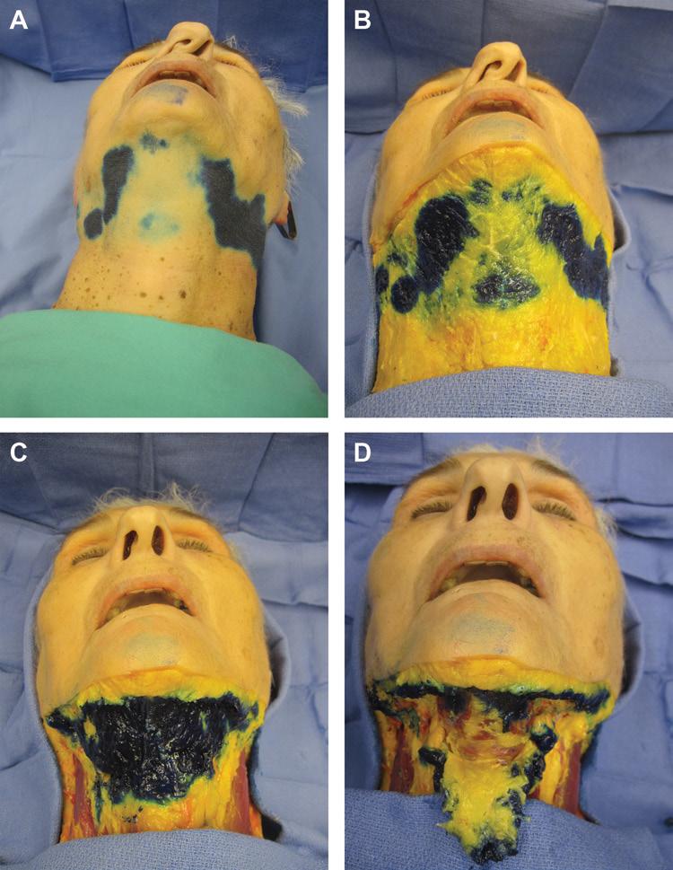 502 Aesthetic Surgery Journal 34(4) Figure 6. A cadaver is shown 24 hours after dye injection in the submental area.