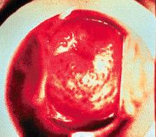 Trichomoniasis Clinical presentation Most men are asymptomatic and are not screened Symptomatic women may have profuse yellowish discharge, vaginal wall inflammation, and/or strawberry