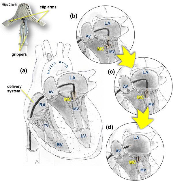 However, despite its conceptual ease, mitraclip implantation still represents a complex procedure, requiring skilled operators, experienced echocardiographists and a high level overall clinical staff