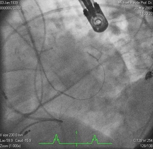 Peri-procedural Coronary Artery Assessment