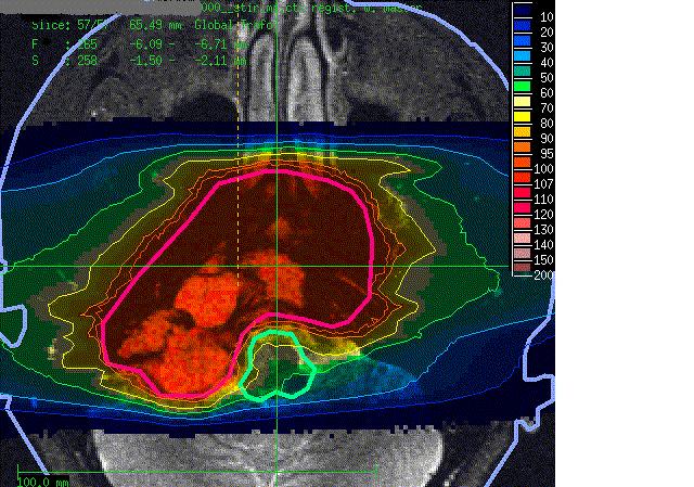 Carbon ion radiotherapy for skull
