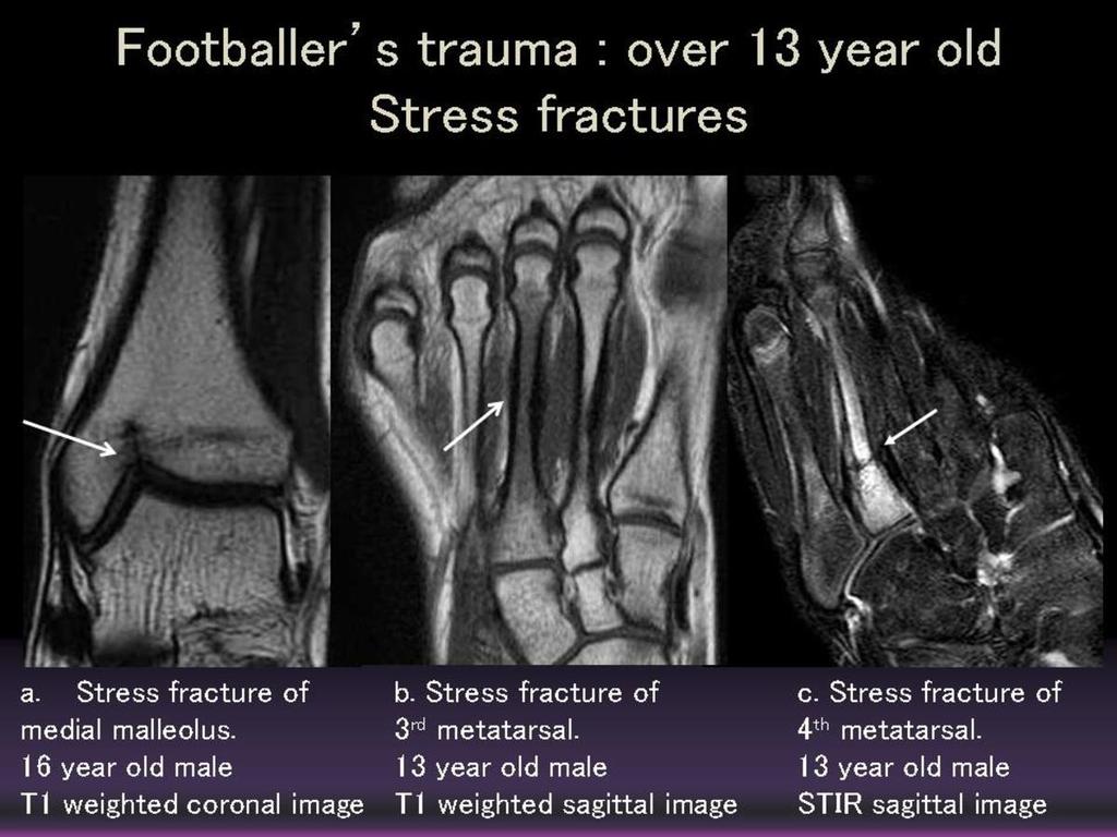 Fig. 4: Footballer's trauma: over 13 years old Stress fracture of medial malleolus an