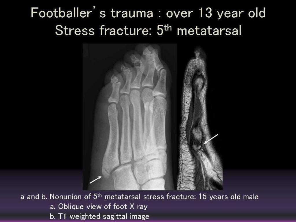 Fig. 5: Nonunion of stress fracture of 5th metarsal (13 year old male) a.
