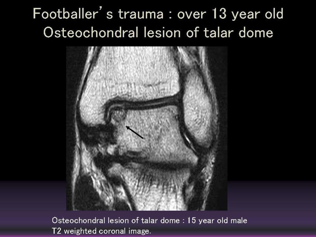 Fig. 6: Osteochondral lesion of talar dome (15 year old male) T2 weighted coronal image: focal signal change is visualized at medial aspect