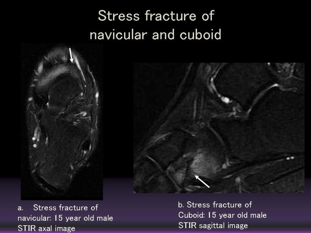 Fig. 7: Traumatic lesions of non-football player Stress fracture of navicular and cuboid a.