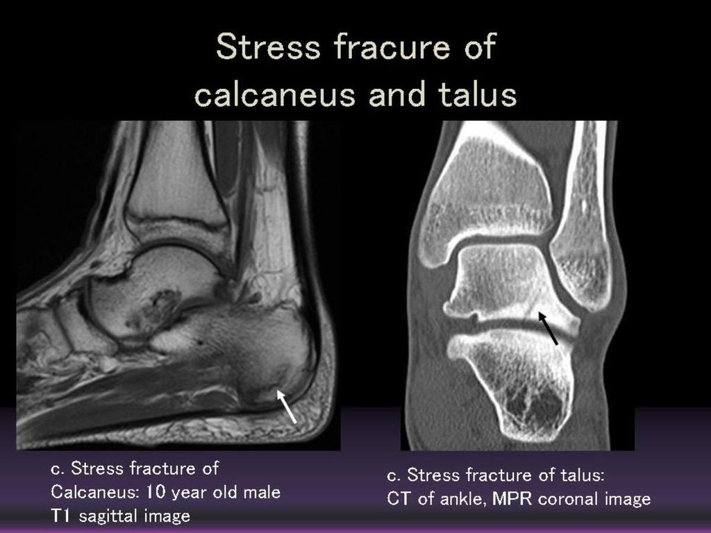 Fig. 8: Stress fracture of calcaneus and talus c.