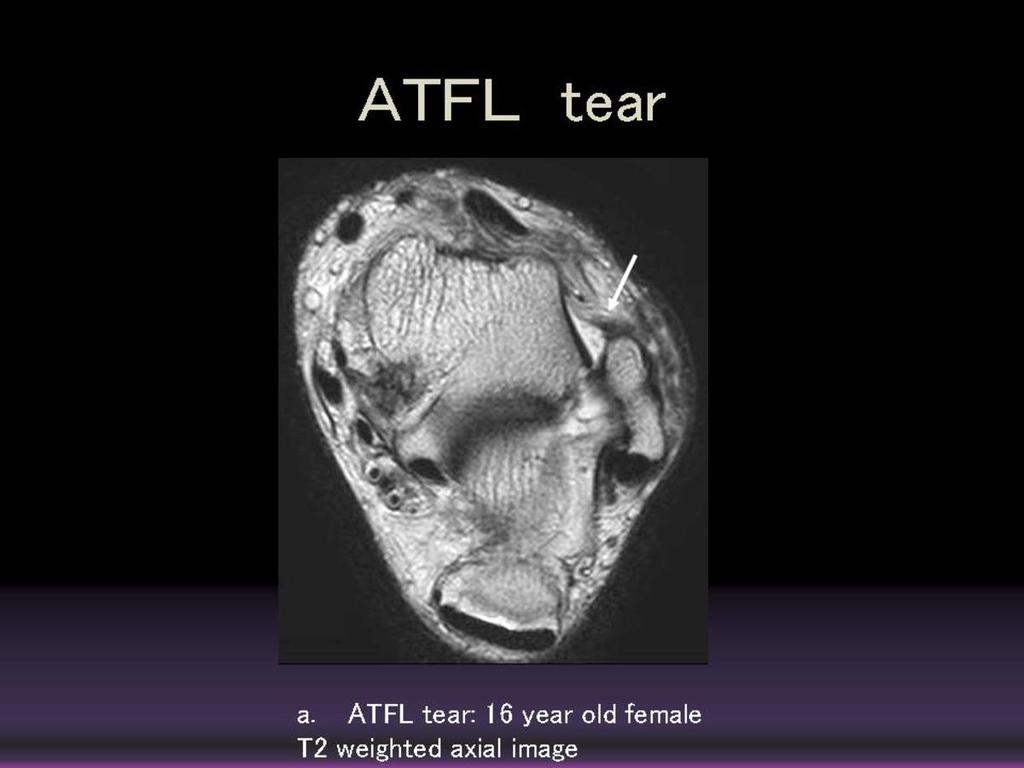 Fig. 9: Anterior talofibular ligament tear T2 weighted axial image (16 years old female): There is evidence of