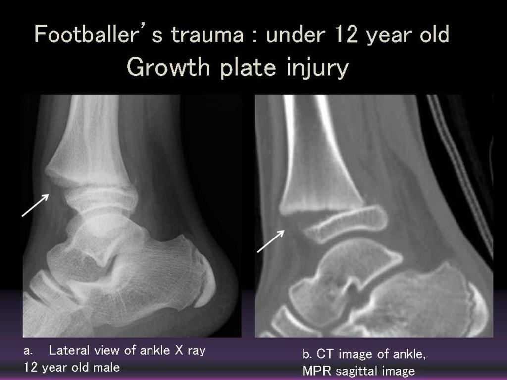 Fig. 3: Growthplate injury (11 year old male) a.lateral view of ankle X ray: widening of growthplate is visualized (arrow). There is no fracture in the tibial epiphysis and metaphysis.