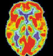 Only 1% of people aged 65 years old have Alzheimer s. 10% of people aged 75 years old have Alzheimer s.