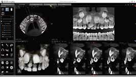 EndoHD mode at 75 µm provides perfect visualization of root and canal morphology.