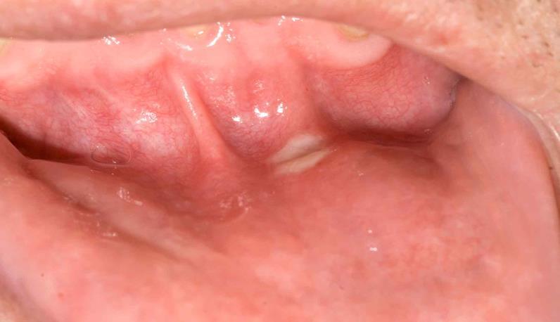 Stomatitis: Clinical Presentation mtor inhibitor-associated stomatitis 1,2 Distinct from chemotherapy-induced stomatitis Aphthous-like ulcers characterized by discrete, ovoid, superficial,