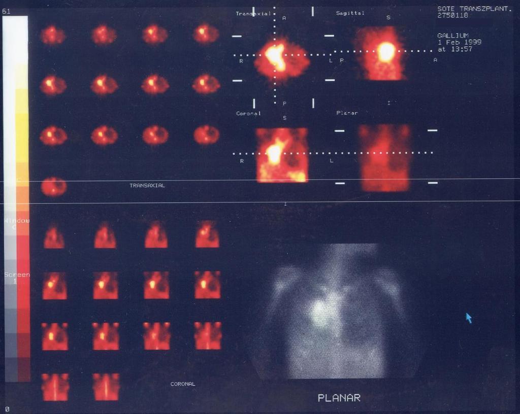 Anterior view and SPECT imaging of the chest Dg: