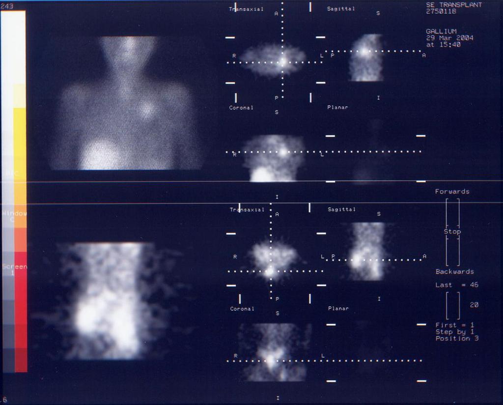 Anterior view and SPECT imaging of the chest Dg: Non-Hodgkin disease after