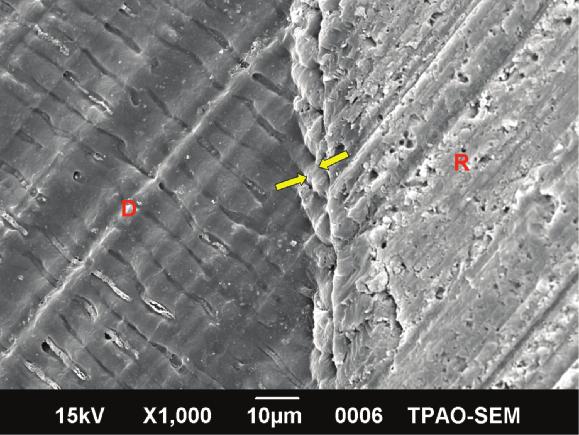Operative Dentistry 342 Figure 3. SEM micrograph (1000x) of the axial dentin region of non-carious sclerotic dentin. In this sample, Single Bond was used after bur removal.
