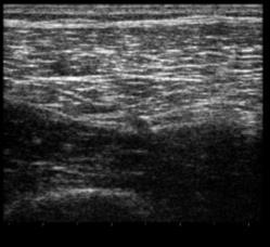 Quadriceps Muscle Transverse Muscle appears speckled