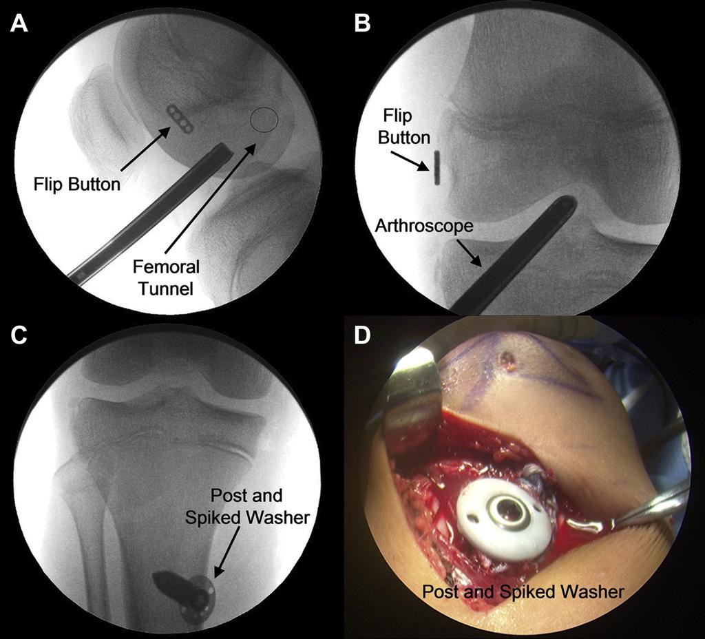 e488 S. E. LEMOS ET AL. Fig 6. The tibial guide pin is drilled in an all-epiphyseal fashion, by use of fluoroscopy and arthroscopy for guidance.
