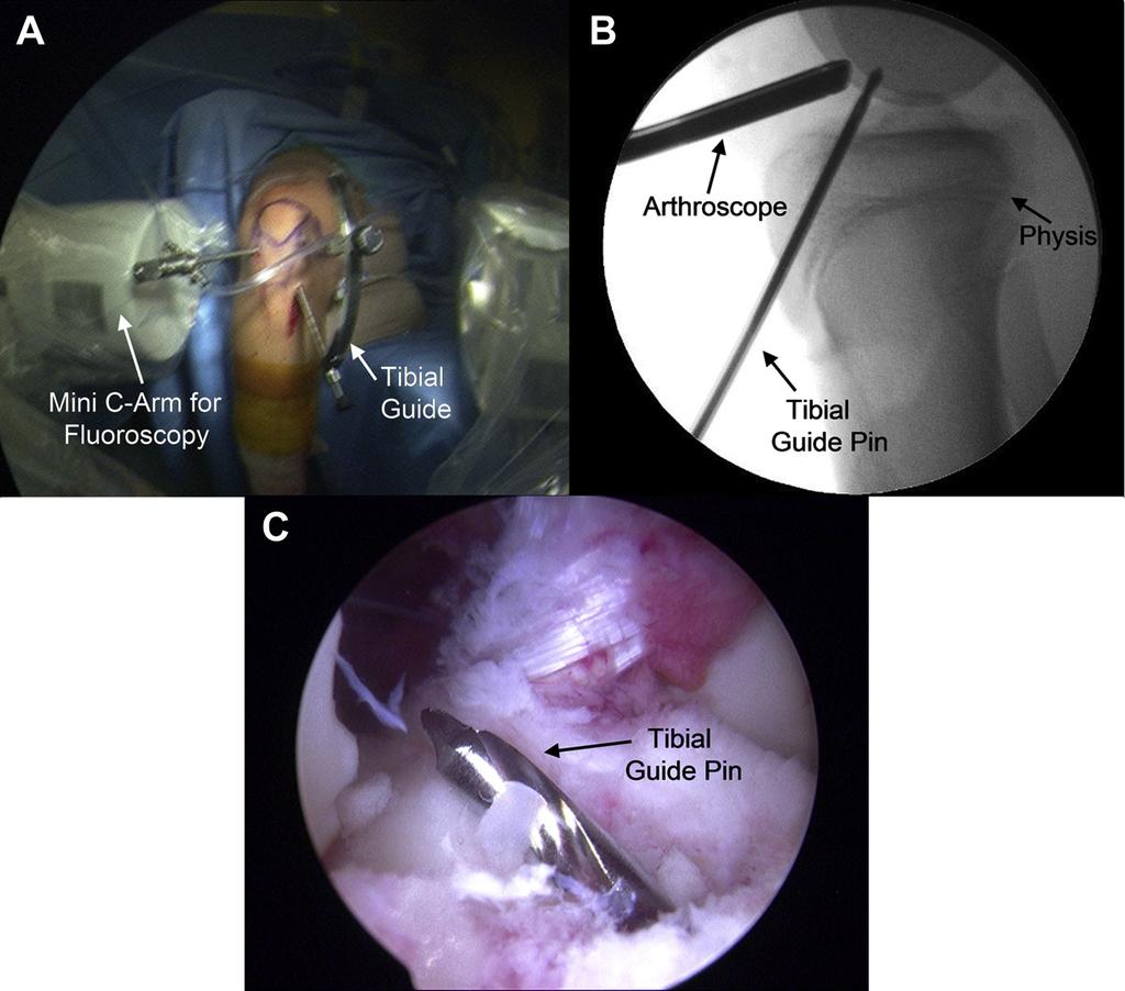 (B) A lateralview fluoroscopic image of the knee is used to avoid the physis while drilling the tibial guide pin.