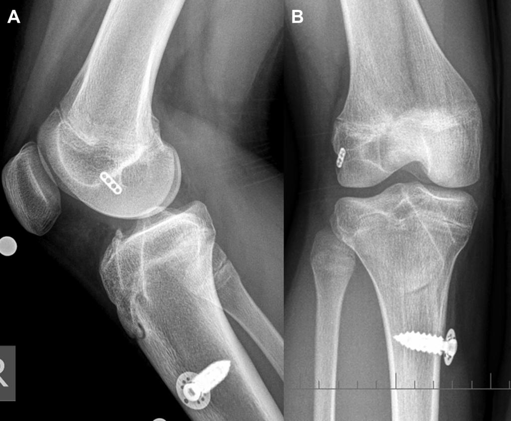 POSTEROMEDIAL PORTAL FOR ACL RECONSTRUCTION e489 Fig 8. Radiographs obtained 14 months postoperatively show femoral and tibial tunnel placement.