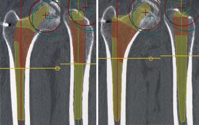 S. Nishihara et al.: Comparison of fit and fill 355 A B Fig. 2. Comparisons of the two femoral components used in this study. A Anteroposterior and lateral views of the Anatomic Hip femoral component.