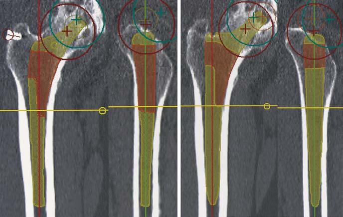 A Anteroposterior and lateral views of the Anatomic Hip femoral component. B Anteroposterior and lateral views of the VerSys Taper femoral component with standard metaphysis femoral components.